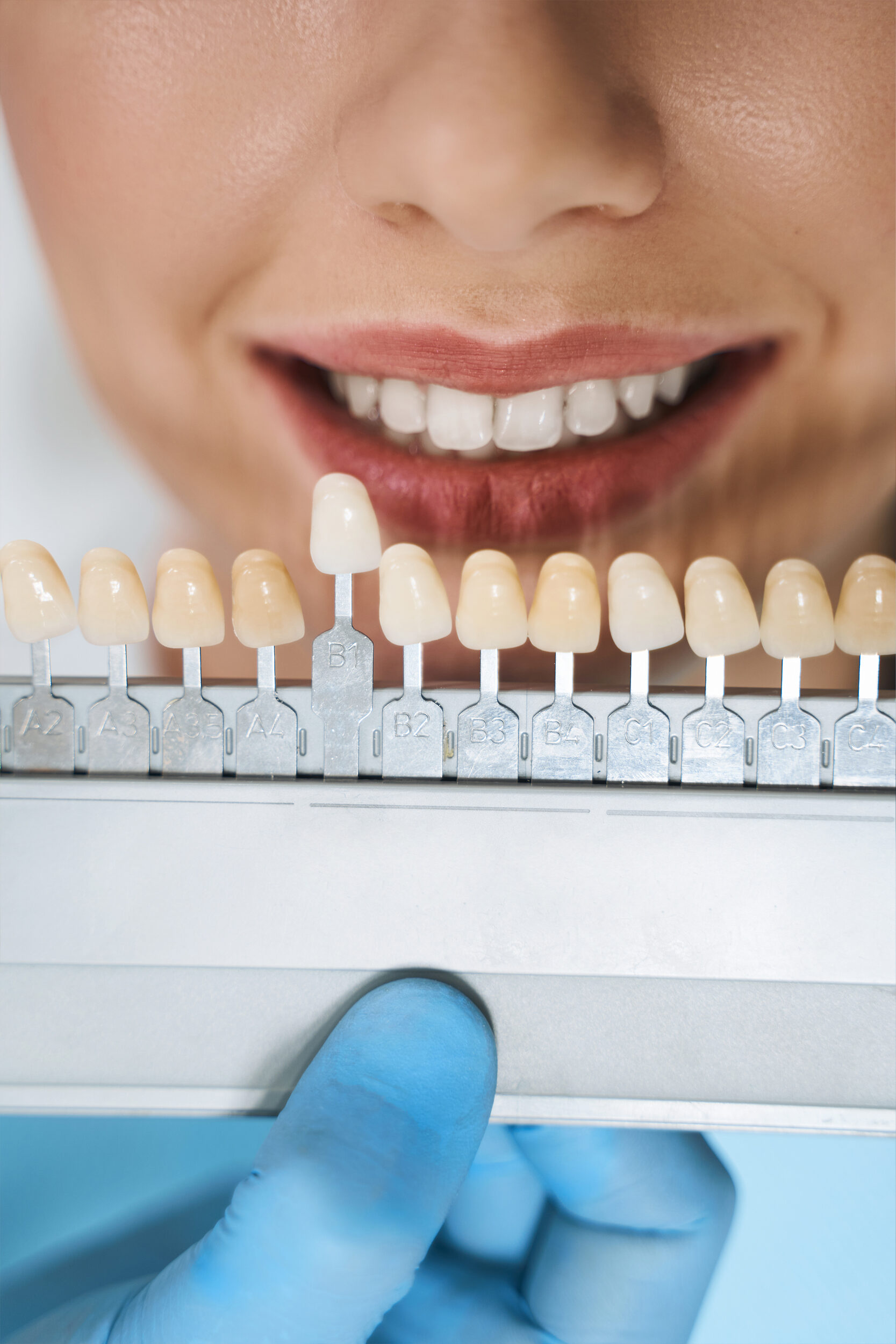Dental Veneers by Coast Dental
